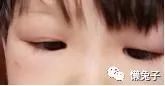 巧用蒲公英治孩子眼睛肿胀医案