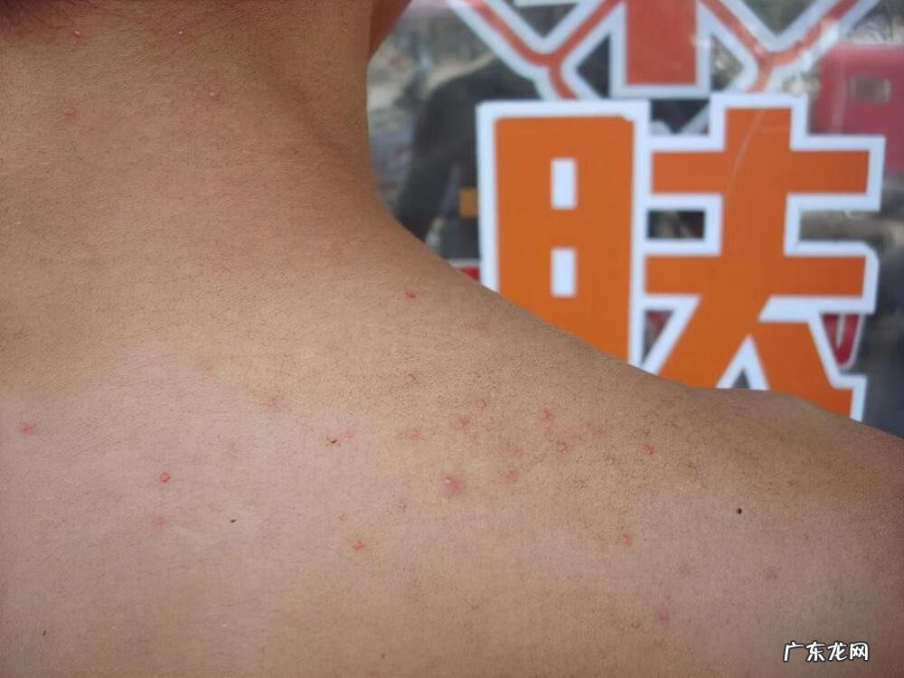 红霉素软膏的十大功效 红霉素软膏的作用及功能主治