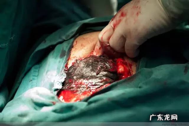 剖腹产全过程图解 剖腹产全过程的图片
