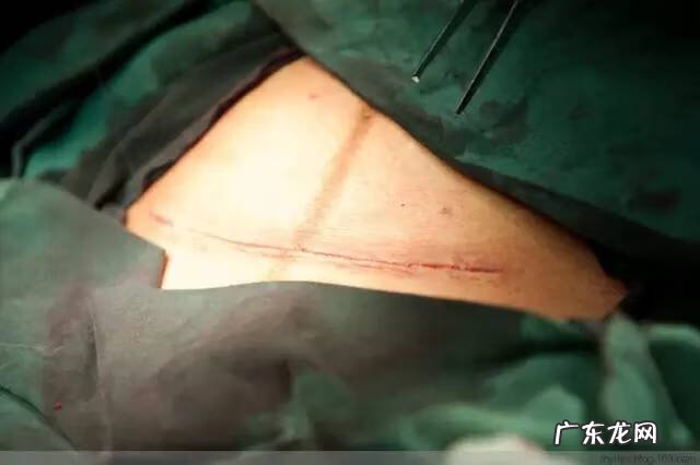 剖腹产全过程图解 剖腹产全过程的图片