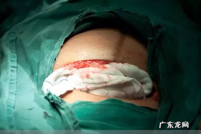 剖腹产全过程图解 剖腹产全过程的图片