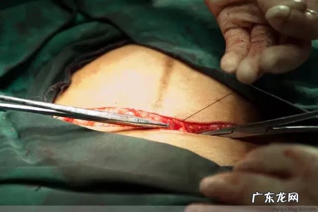 剖腹产全过程图解 剖腹产全过程的图片