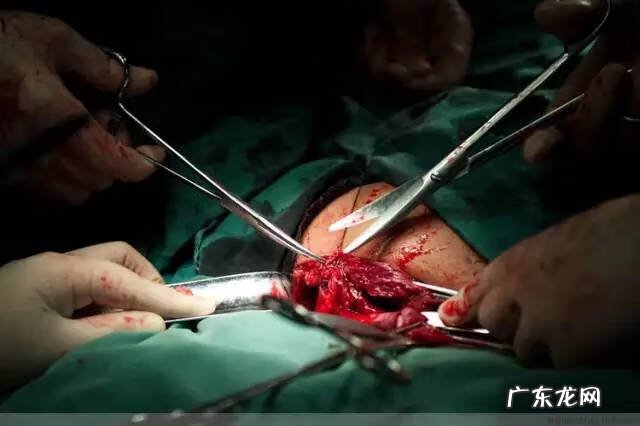 剖腹产全过程图解 剖腹产全过程的图片