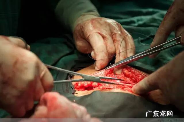 剖腹产全过程图解 剖腹产全过程的图片