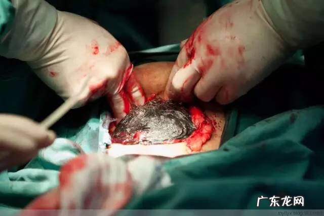 剖腹产全过程图解 剖腹产全过程的图片
