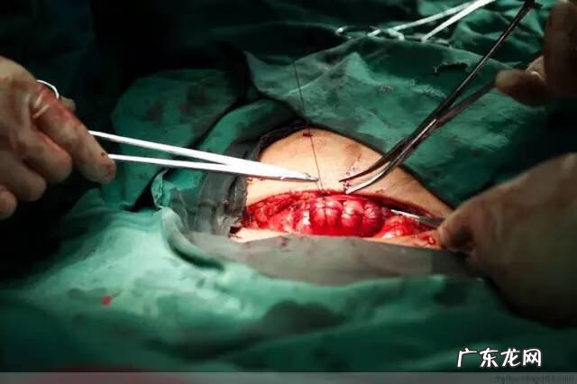 剖腹产全过程图解 剖腹产全过程的图片