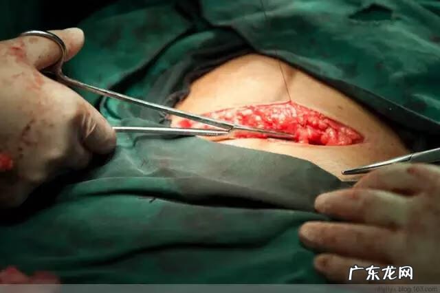 剖腹产全过程图解 剖腹产全过程的图片