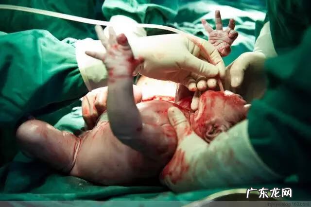 剖腹产全过程图解 剖腹产全过程的图片