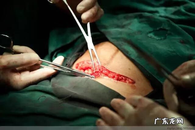 剖腹产全过程图解 剖腹产全过程的图片