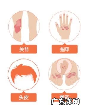 头皮牛皮皮癣怎么造成的 头皮有牛癣