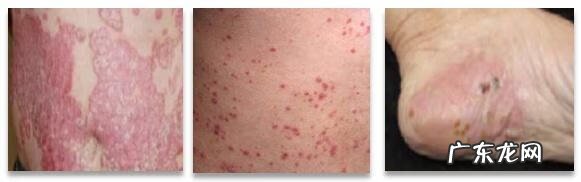 头皮牛皮皮癣怎么造成的 头皮有牛癣