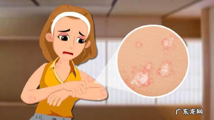 头皮牛皮皮癣怎么造成的 头皮有牛癣