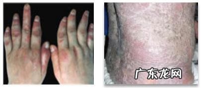 头皮牛皮皮癣怎么造成的 头皮有牛癣