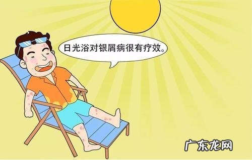 头皮牛皮皮癣怎么造成的 头皮有牛癣