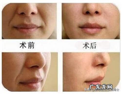 法令纹出来了还能消除吗 法令纹怎么消除法令纹