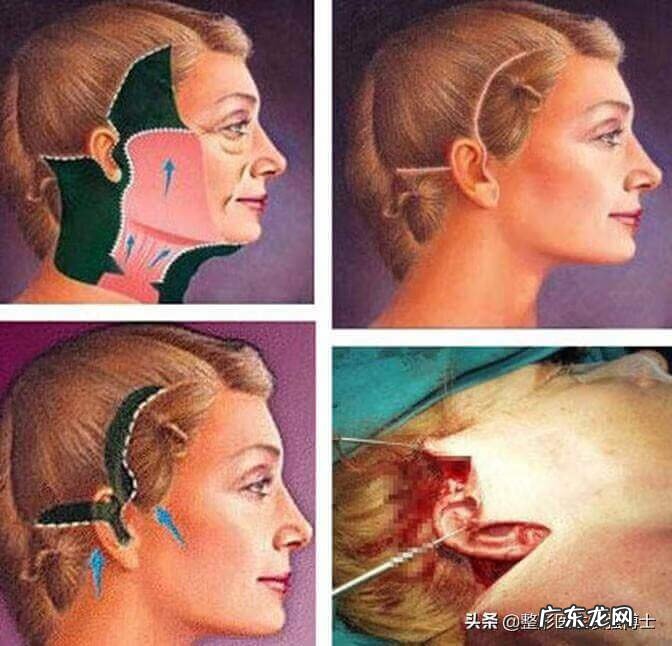 法令纹出来了还能消除吗 法令纹怎么消除法令纹