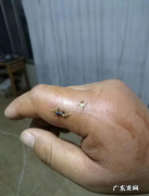 被马蜂蛰了有事吗 马蜂蛰了怎么解决在家