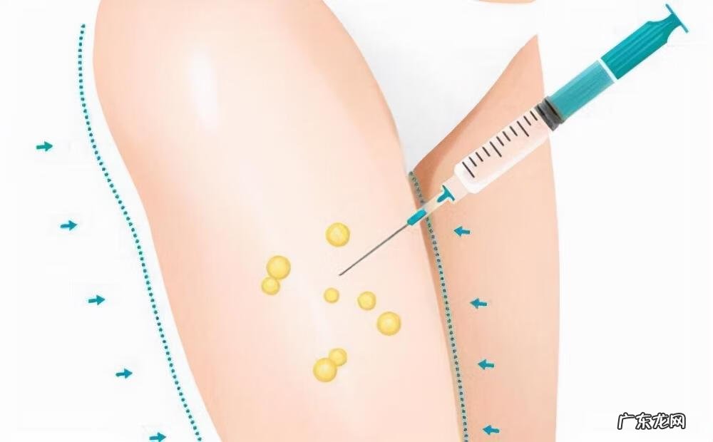 腿部吸脂减肥需要多少钱 腿部吸脂多少钱大概