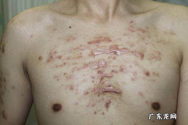 胸口有疤痕的人命运 胸口有疤痕有风水影响吗