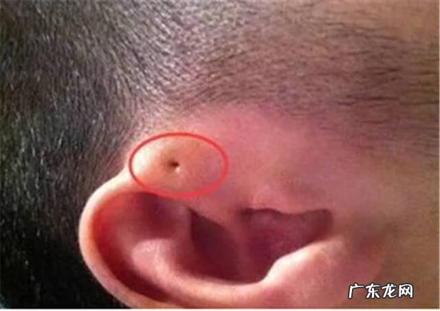 耳朵后面有两个小坑 耳朵上有小坑好不好