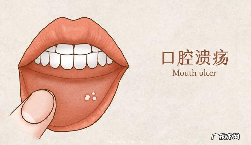 口腔溃疡位置不同 口腔溃疡位置不同代表什么