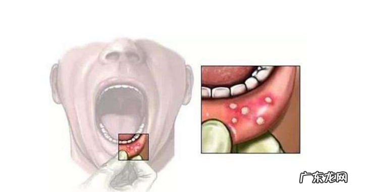 口腔溃疡位置不同 口腔溃疡位置不同代表什么