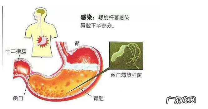 感染幽门螺杆菌到 感染幽门螺杆菌到胃癌需要几步
