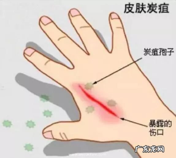 山东省出现炭疽死 山东省出现炭疽死亡病例