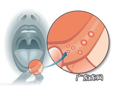 嘴里起泡是甚么原 嘴里起泡是什么原因引起的