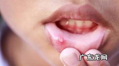 嘴里起泡怎样快速 嘴里起泡怎么快速好