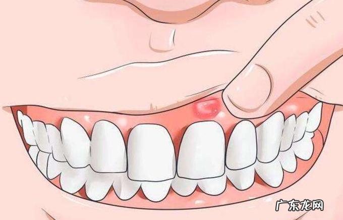 口腔溃疡吃甚么水 口腔溃疡吃什么水果好得快