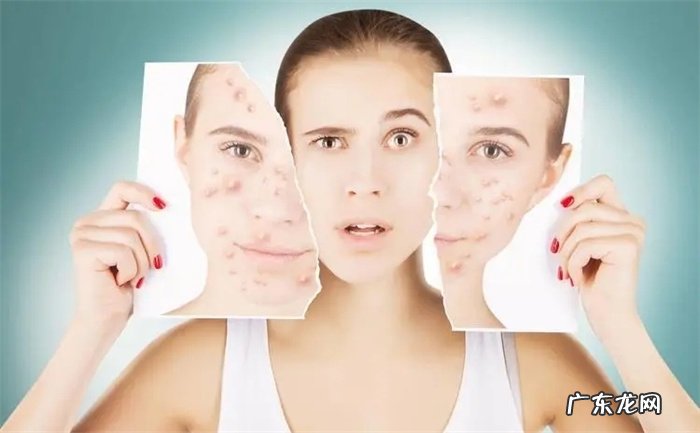 只需治疗有痘印的地方 青春痘治疗有几个误区