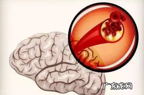 脑梗拍打三天见奇效真的假的