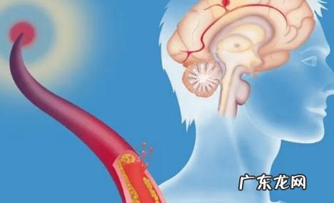 脑梗拍打三天见奇效真的假的