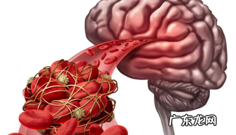 脑梗拍打三天见奇效真的假的