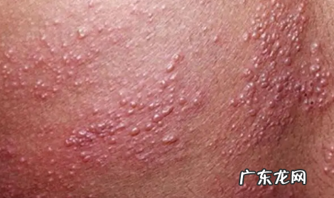 疱疹刚开始症状图片