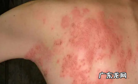 疱疹刚开始症状图片