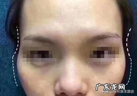 颧骨宽和颧骨高