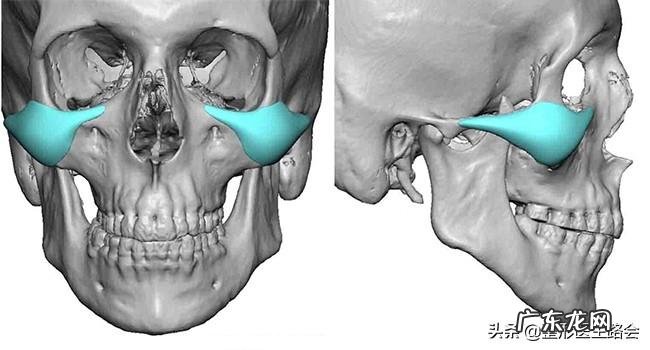 颧骨宽和颧骨高