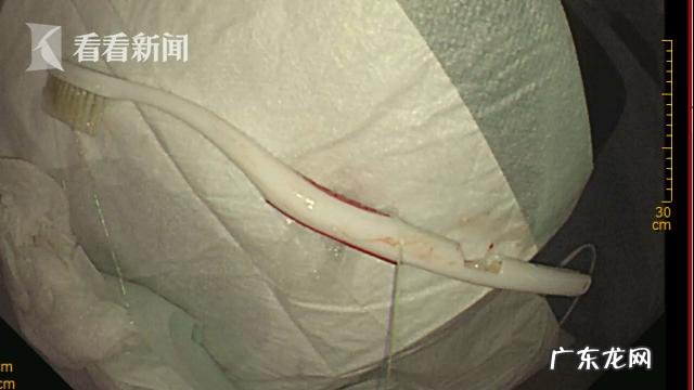 男子吞下20厘米长牙刷 小伙清理舌苔误吞18厘米长牙刷