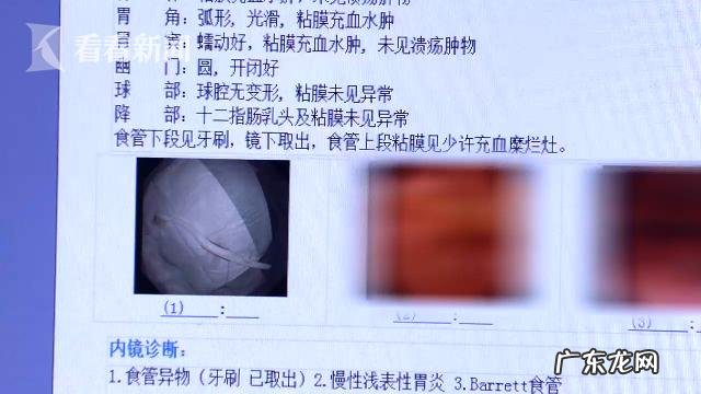 男子吞下20厘米长牙刷 小伙清理舌苔误吞18厘米长牙刷