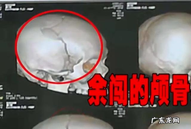 谁该承担赔偿责任 铁架高空坠落男童被砸颅骨碎裂