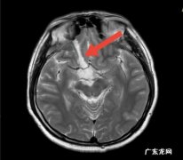 不采摘！不食用！不买卖！浙江一地1个月内已有18人中招 筷子插电座手指被切