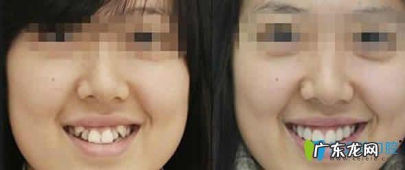 牙科医生告诉你该怎么处理 虎牙掉了做不了种植牙怎么办