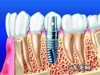 种后可以管多久 种植牙安全吗怎么收费