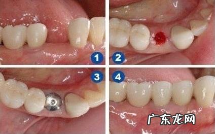 种牙后多久才能戴牙冠呢 种植牙的冠怎么戴怎么拿下来