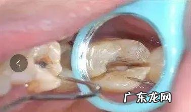 种牙后多久才能戴牙冠呢 种植牙的冠怎么戴怎么拿下来