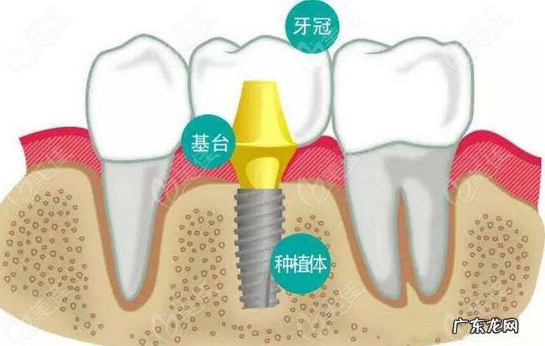 看看专业牙医的说法 种植牙齿牙龈痛怎么办