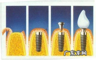 不吹不黑,今天给你说清楚 镶牙种植牙怎么样