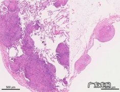 「牙齿那些事儿」No.28 种植牙手术后长肉芽怎么办